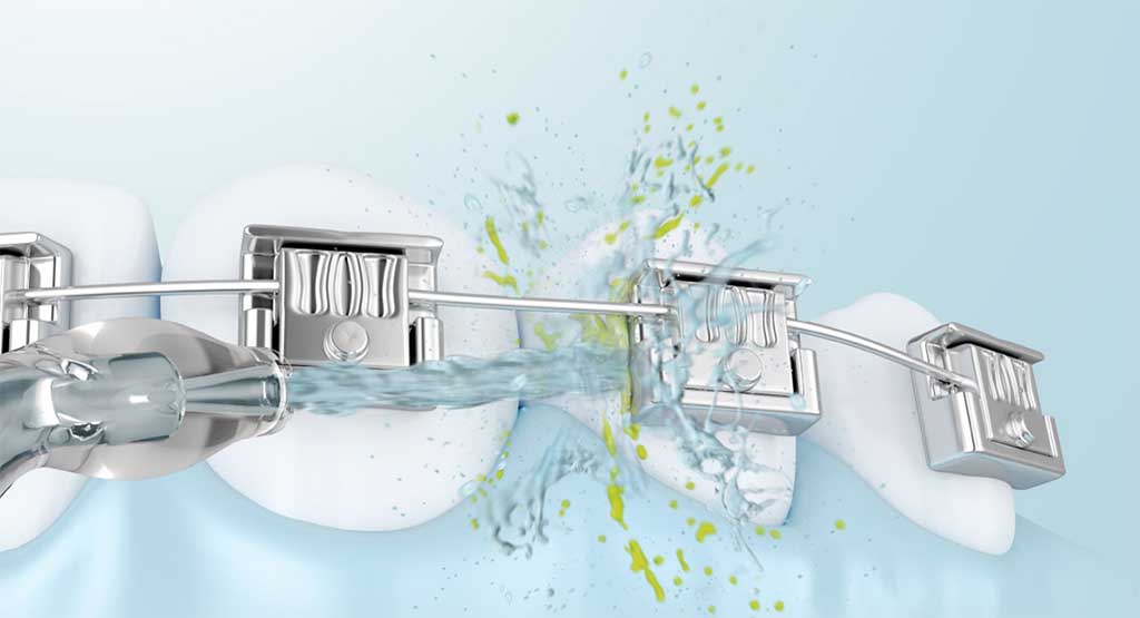 Chức năng chăm sóc làm sạch thiết bị chỉnh nha của máy tăm nước